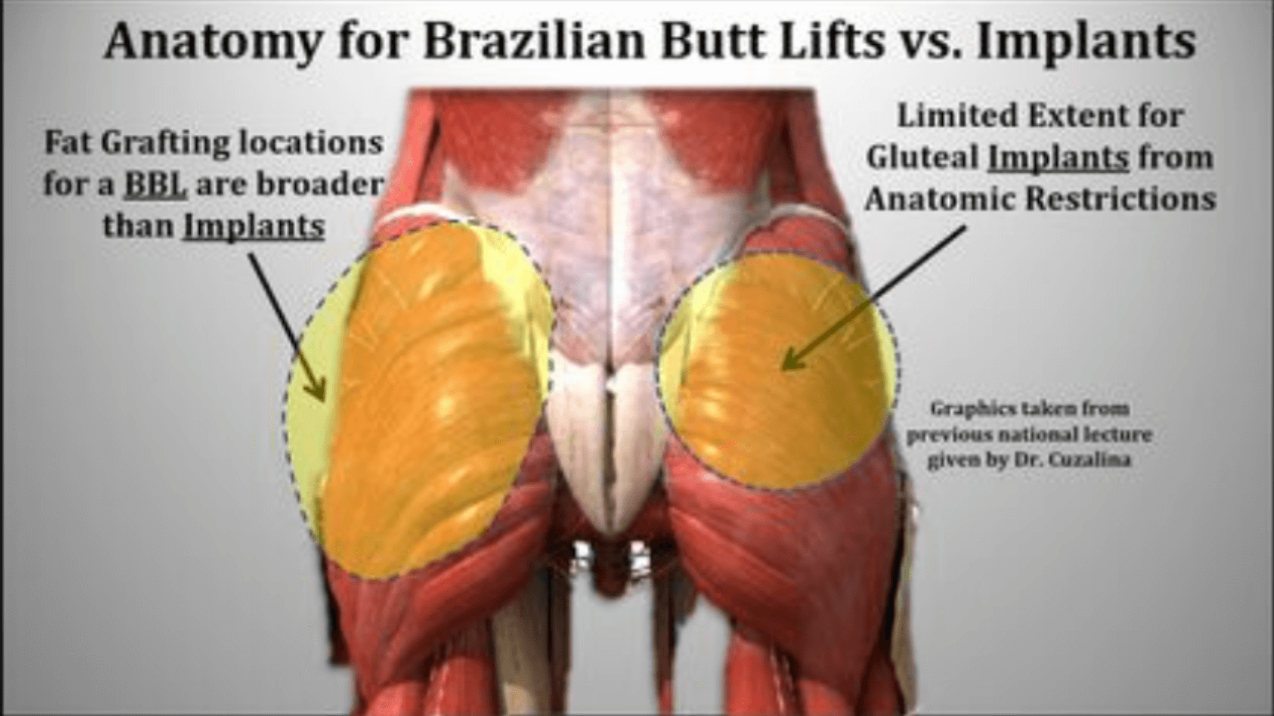 anatomy of bbl vs implants